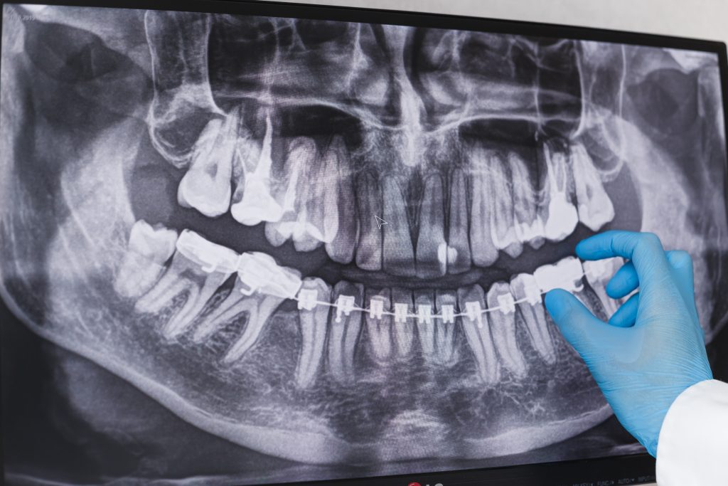 Pantomogram – zdjęcie panoramiczne zębów