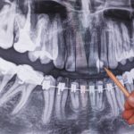 Pantomogram – zdjęcie panoramiczne zębów