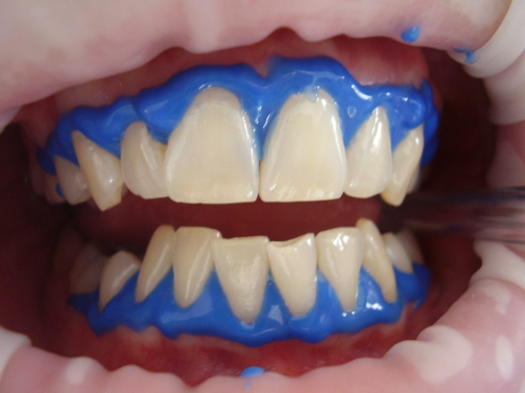 Wybielanie zębów – na czym polega zabieg?