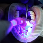 Wybielanie zębów – przeciwskazania