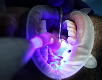 Wybielanie zębów – przeciwskazania