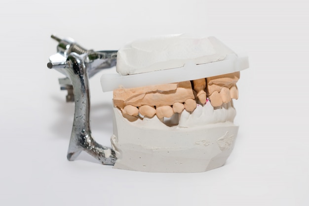 Jak wygląda proteza zębowa szkieletowa i na co zwrócić uwagę?