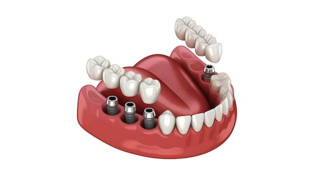 Jak wygląda mostek na zęby i kiedy warto go rozważyć?