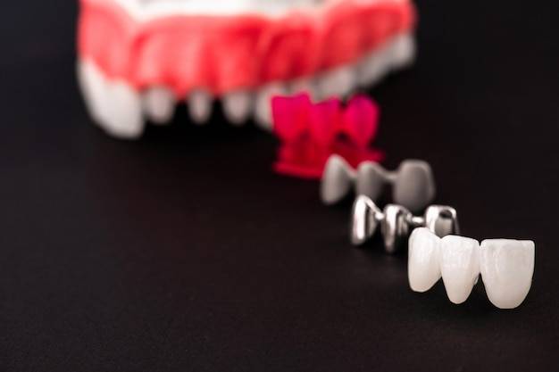 Kiedy implant jest najlepszym rozwiązaniem dla brakującego zęba?