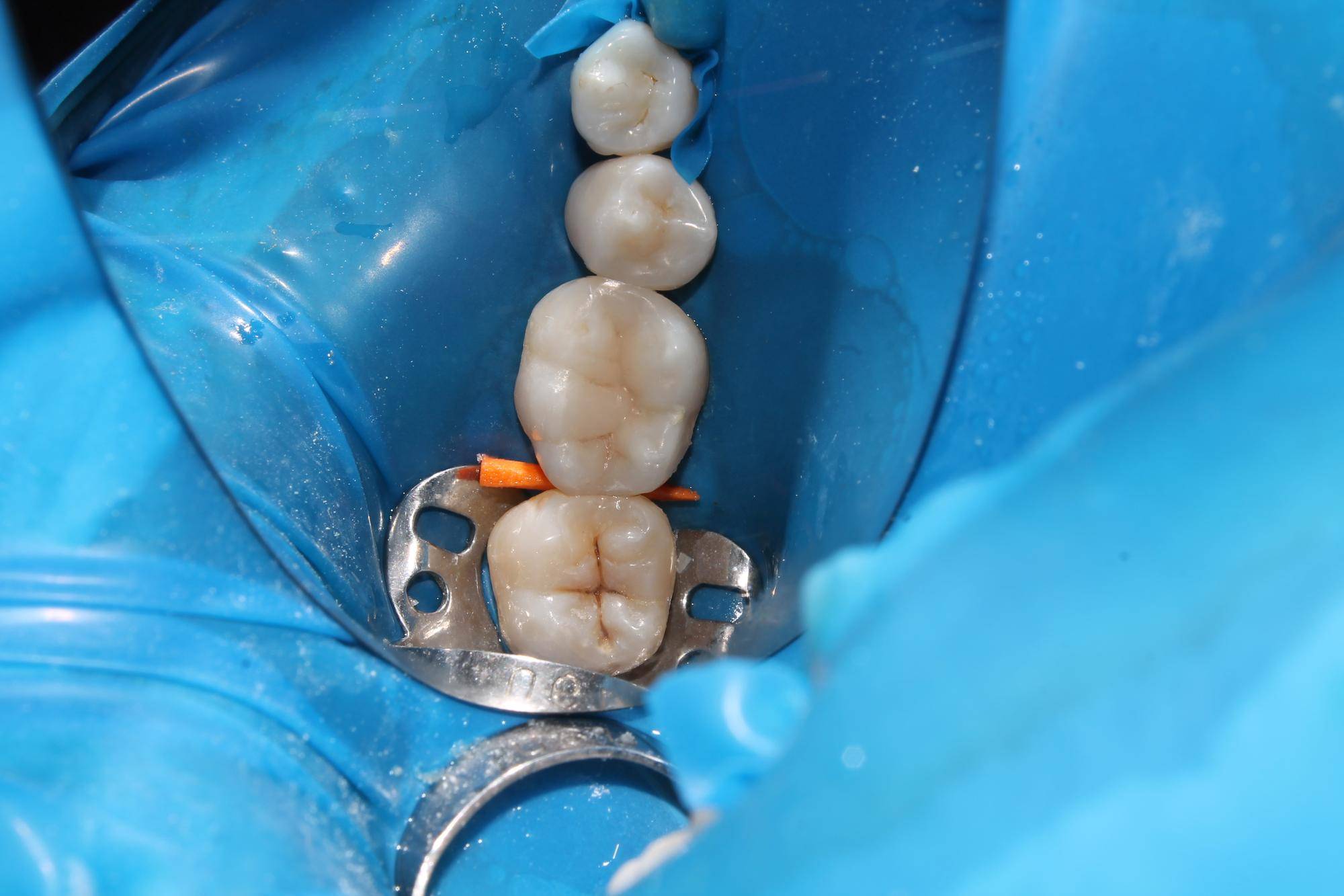 Ile kosztuje odbudowa zęba dwójki u dentysty?