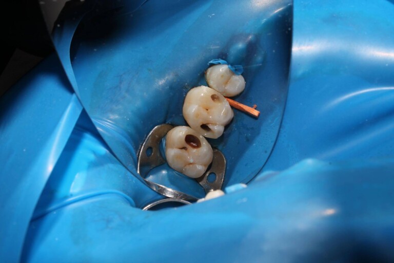 Z czego jest plomba dentystyczna i jak wybierane są jej materiały?