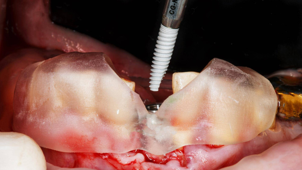 Ile trwa założenie implantu zęba i co wpływa na czas leczenia?