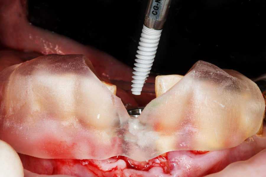 Jak wstawia się implant zęba i czego można się spodziewać po zabiegu?