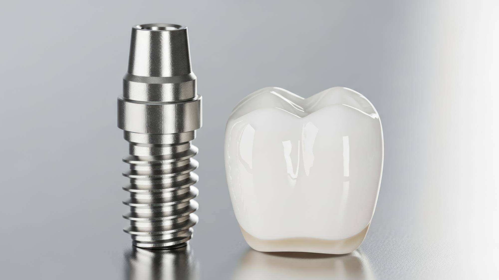 Jaka korona na implant będzie odpowiednia dla Ciebie?